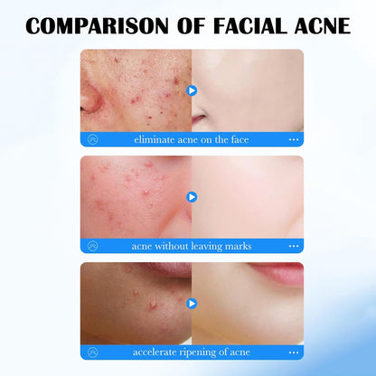 Pimple Acne Patches